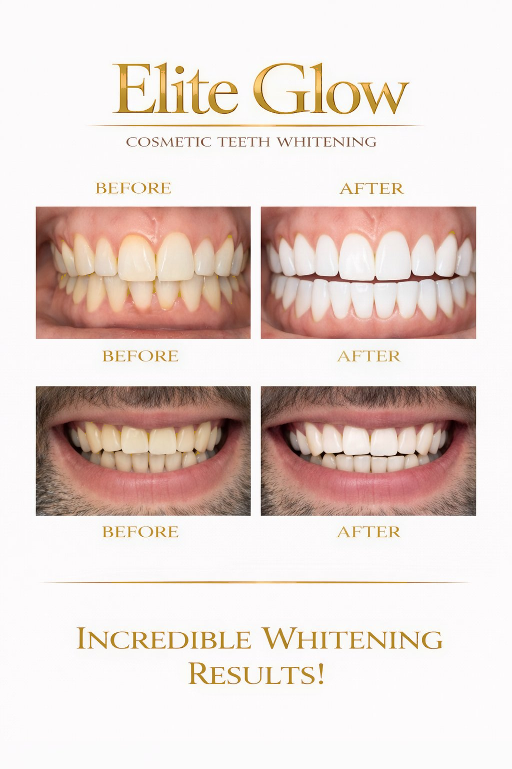 Before and after teeth whitening results